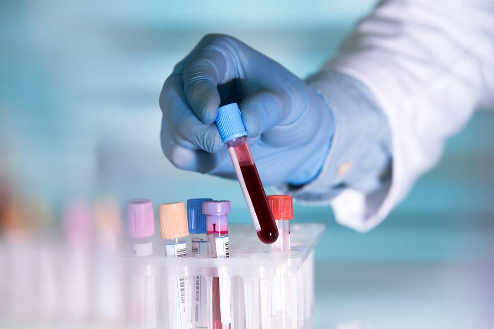 Nuovi esami: test ST2 PRESAGE per la prevenzione cardiaca